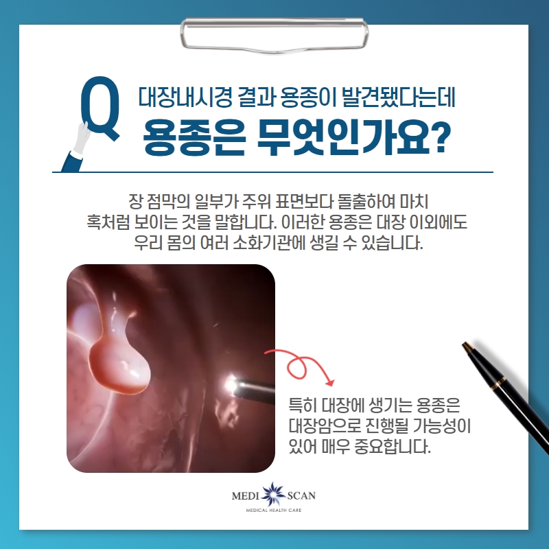 용종 제거