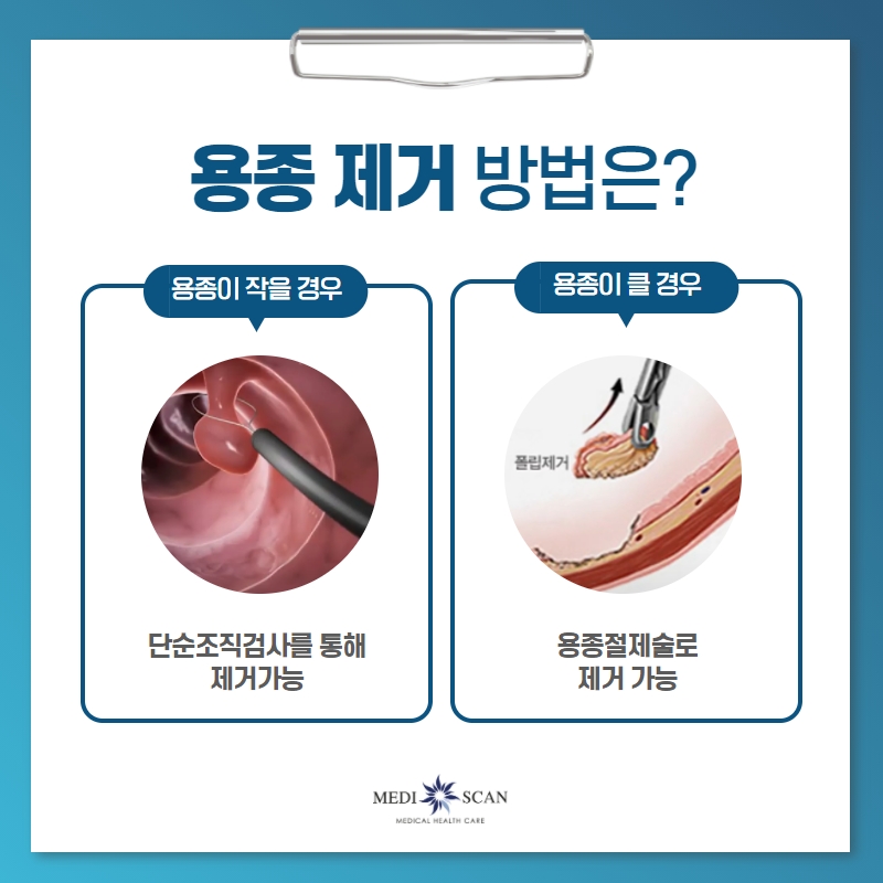 용종 제거