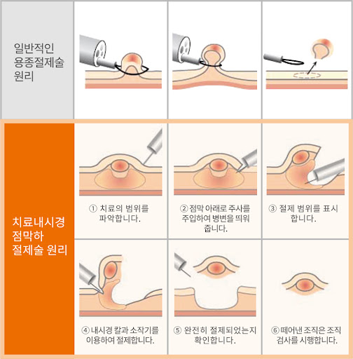 용종 제거