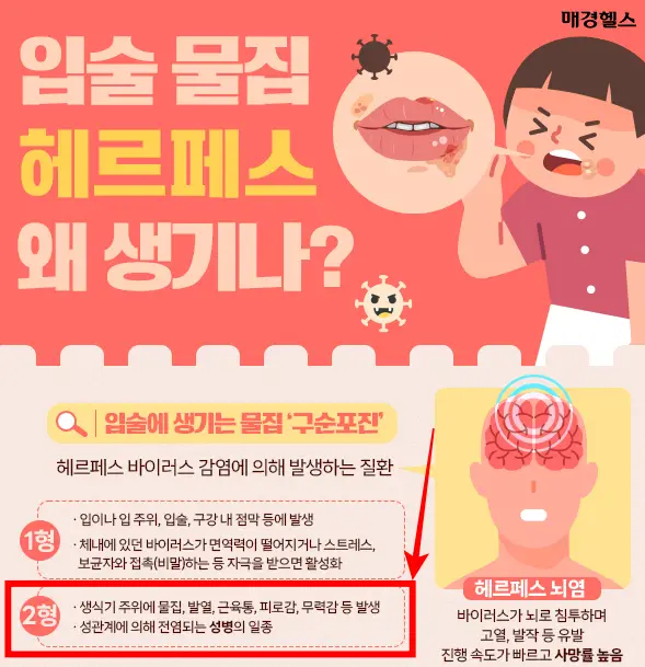 헤르페스 2형